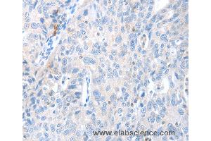 Immunohistochemistry of Human ovarian cancer using MAGEB4 Polyclonal Antibody at dilution of 1:40