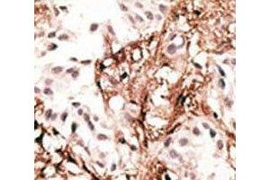 IHC analysis of FFPE human breast carcinoma tissue stained with the LC3C antibody (LC3C antibody  (AA 1-30))