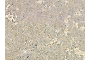 ABIN6261032 and ABIN6276527 at 1/100 staining human melanoma by IHC-P. (CRH antibody  (N-Term))