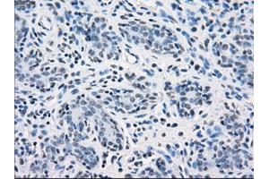 Immunohistochemical staining of paraffin-embedded breast tissue using anti-SORD mouse monoclonal antibody.