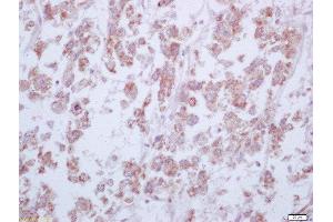 Formalin-fixed and paraffin embedded human liver carcinoma labeled with Anti-Arginase 1 Polyclonal Antibody, Unconjugated  at 1:200 followed by conjugation to the secondary antibody and DAB staining (Liver Arginase antibody  (AA 151-220))