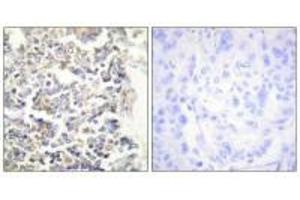 Immunohistochemistry analysis of paraffin-embedded human lung carcinoma tissue using MARK3 antibody. (MARK3 antibody  (N-Term))