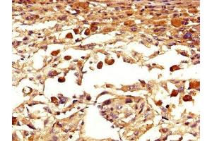 IHC image of ABIN7151810 diluted at 1:400 and staining in paraffin-embedded human melanoma performed on a Leica BondTM system. (EOMES antibody  (AA 562-676))