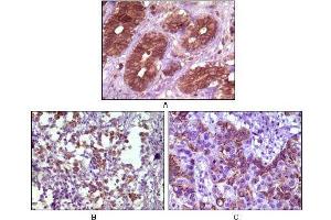 Immunohistochemical analysis of paraffin-embedded human breast tissue (A), lymph tissue (B) and skin carcinoma (C), showing membrane localization using BLK mouse mAb with DAB staining. (BLK antibody)