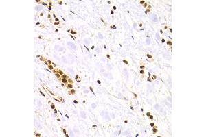 Immunohistochemistry of paraffin-embedded human gastric cancer using RAD50 Antibody. (RAD50 antibody)