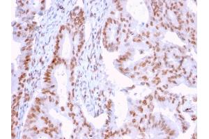 Formalin-fixed, paraffin-embedded human Breast Carcinoma stained with CLEC9A Mouse Monoclonal Antibody (2H12/4). (DMC1 antibody)