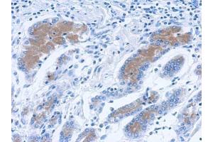 IHC-P Image Immunohistochemical analysis of paraffin-embedded human colon carcinoma, using Annexin II antibody, antibody at 1:500 dilution. (Annexin A2 antibody)