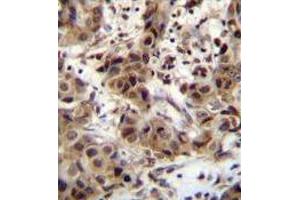 ZNF321 Antibody (N-term) immunohistochemistry analysis in formalin fixed and paraffin embedded human breast carcinoma followed by peroxidase conjugation of the secondary antibody and DAB staining.
