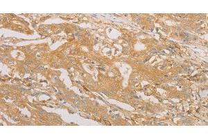Immunohistochemistry of paraffin-embedded Human gastric cancer tissue using CD40 Polyclonal Antibody at dilution 1:70 (CD40 antibody)