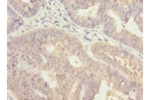 Immunohistochemistry of paraffin-embedded human endometrial cancer using ABIN7143769 at dilution of 1:100 (ALG2 antibody  (AA 197-416))