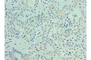 Immunohistochemistry of paraffin-embedded human breast cancer using ABIN7162890 at dilution of 1:100 (ADRP antibody  (AA 168-437))