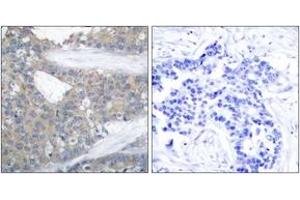 Immunohistochemistry analysis of paraffin-embedded human breast carcinoma tissue, using Paxillin (Ab-31) Antibody.