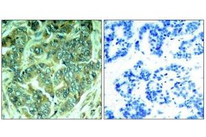 Immunohistochemical analysis of paraffin-embedded human breast carcinoma tissue using p62Dok(Phospho-Tyr398) Antibody(left) or the same antibody preincubated with blocking peptide(right). (DOK1 antibody  (pTyr398))
