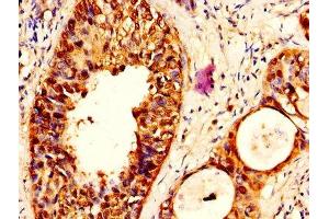 IHC image of ABIN7169337 diluted at 1:500 and staining in paraffin-embedded human cervical cancer performed on a Leica BondTM system. (SERPINB3 antibody  (AA 2-383))