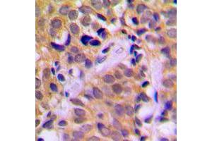 Immunohistochemical analysis of CHRNA1 staining in human prostate cancer formalin fixed paraffin embedded tissue section. (CHRNA1 antibody  (Center))
