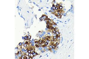 Immunohistochemistry of paraffin-embedded human liver cancer using C-Reactive Protein (C-Reactive Protein (CRP)) Rabbit mAb (ABIN7265972) at dilution of 1:100 (40x lens). (CRP antibody)