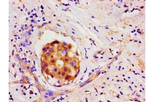 Immunohistochemistry of paraffin-embedded human breast cancer using ABIN7165746 at dilution of 1:100