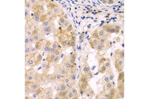 Immunohistochemistry of paraffin-embedded human liver cancer using SULT2B1 antibody at dilution of 1:100 (x40 lens). (SULT2B1 antibody)