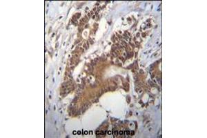 PCYT1A Antibody immunohistochemistry analysis in formalin fixed and paraffin embedded human colon carcinoma followed by peroxidase conjugation of the secondary antibody and DAB staining.