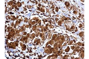 IHC-P Image MMP2 antibody detects MMP2 protein at cytosol and nucleus on human breast carcinoma by immunohistochemical analysis. (MMP2 antibody)