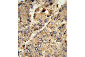 Formalin-fixed and paraffin-embedded human hepatocarcinoma reacted with XDH Antibody (N-term), which was peroxidase-conjugated to the secondary antibody, followed by DAB staining. (XDH antibody  (N-Term))