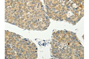 The image on the left is immunohistochemistry of paraffin-embedded Human liver cancer tissue using ABIN7128020(SPIN4 Antibody) at dilution 1/20, on the right is treated with fusion protein. (SPIN4 antibody)
