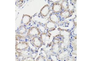 Immunohistochemistry of paraffin-embedded human breast cancer using PDCD10 antibody (ABIN7269540) at dilution of 1:100 (40x lens). (PDCD10 antibody  (AA 1-212))