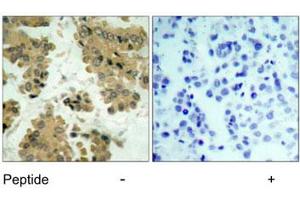 Immunohistochemical analysis of paraffin-embedded human lung carcinoma tissue using AKT2 polyclonal antibody . (AKT2 antibody)