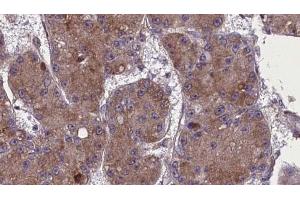ABIN6272765 at 1/100 staining Human liver cancer tissue by IHC-P. (OR52R1 antibody)