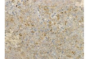 ABIN6266251 and ABIN6277406 at 1/100 staining human melanoma by IHC-P.
