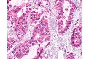 Anti-XPR1 antibody IHC of human Breast, Carcinoma. (xpr1 antibody  (C-Term))