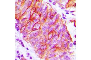 Immunohistochemical analysis of CD147 staining in human prostate cancer formalin fixed paraffin embedded tissue section.
