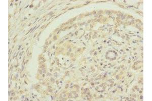 Immunohistochemistry of paraffin-embedded human pancreatic cancer using ABIN7151440 at dilution of 1:100 (EDIL3 antibody  (AA 60-300))