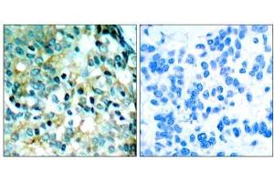 Immunohistochemical analysis of paraffin- embedded human breast carcinoma tissue using Src (phospho- Tyr418) antibody (E011091). (Src antibody  (pTyr418))