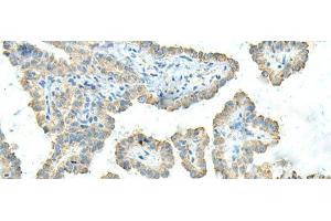 Immunohistochemistry of paraffin-embedded Human thyroid cancer tissue using FCGRT Polyclonal Antibody at dilution of 1:45(x200) (FcRn antibody)