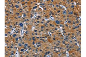 The image on the left is immunohistochemistry of paraffin-embedded Human liver cancer tissue using ABIN7130272(MSH5 Antibody) at dilution 1/30, on the right is treated with fusion protein. (MSH5 antibody)