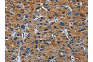 The image on the left is immunohistochemistry of paraffin-embedded Human liver cancer tissue using ABIN7130272(MSH5 Antibody) at dilution 1/30, on the right is treated with fusion protein.