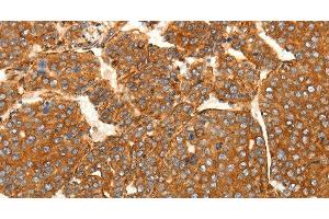 Immunohistochemistry of paraffin-embedded Human liver cancer tissue using SFRP1 Polyclonal Antibody at dilution 1:80 (SFRP1 antibody)