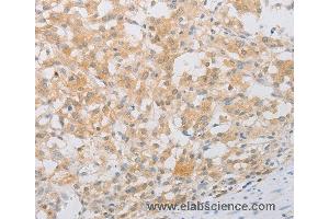 Immunohistochemistry of Human thyroid cancer using PDE4D Polyclonal Antibody at dilution of 1:20 (PDE4D antibody)