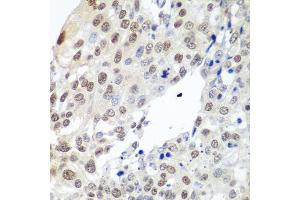 Immunohistochemistry of paraffin-embedded human lung cancer using PTTG1 antibody (ABIN5974823) at dilution of 1/100 (40x lens). (PTTG1 antibody)