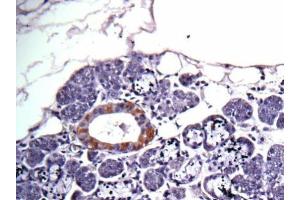 IHC-P Image Immunohistochemical analysis of human salivary gland cancer, using CAD, antibody at 1:100 dilution. (CAD antibody  (C-Term))