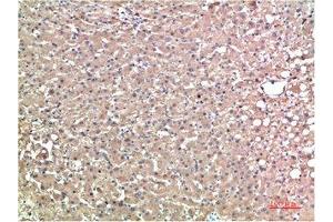 Immunohistochemical analysis of paraffin-embedded Human Liver Carcinoma Tissue using TTR Mouse mAb diluted at 1:200. (TTR antibody)
