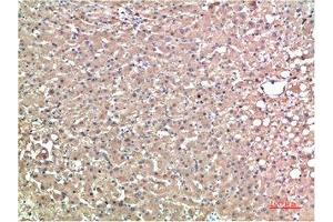 Immunohistochemical analysis of paraffin-embedded Human Liver Carcinoma Tissue using TTR Mouse mAb diluted at 1:200. (TTR antibody)