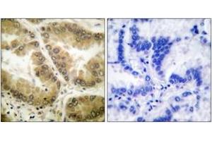 Immunohistochemistry analysis of paraffin-embedded human lung carcinoma tissue, using HDAC7 Antibody.