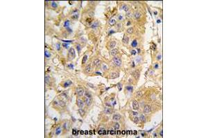 Formalin-fixed and paraffin-embedded human breast carcinoma tissue reacted with MIPEP antibody , which was peroxidase-conjugated to the secondary antibody, followed by DAB staining.