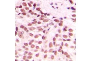 Immunohistochemical analysis of GADD153 staining in human breast cancer formalin fixed paraffin embedded tissue section. (DDIT3 antibody  (Center))