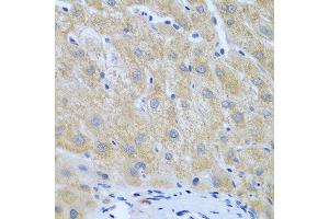 Immunohistochemistry of paraffin-embedded human liver cancer using FURIN antibody at dilution of 1:100 (40x lens). (FURIN antibody)