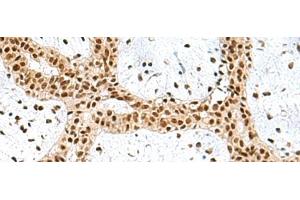 Immunohistochemistry of paraffin-embedded Human breast cancer tissue using PRPF40A Polyclonal Antibody at dilution of 1:60(x200) (PRPF40A antibody)