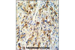 Formalin-fixed and paraffin-embedded human hepatocarcinoma reacted with CECR5 Antibody , which was peroxidase-conjugated to the secondary antibody, followed by DAB staining. (CECR5 antibody  (AA 164-190))