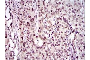 Immunohistochemical analysis of paraffin-embedded cervical cancer tissues using PCNA mouse mAb with DAB staining. (PCNA antibody  (AA 53-196))